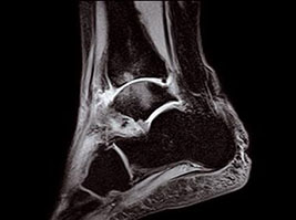 csm oscan Ankle STIR Sagittal