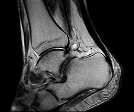 oscan Ankle FSE T2 Sagittal