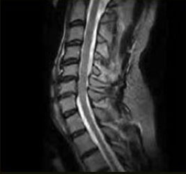 csm s scan C spine FSE T2 Sagittal