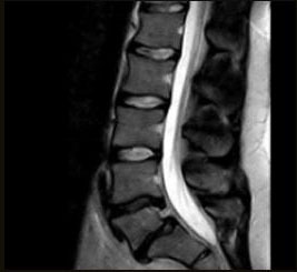 csm s scan L spine FSE T2 Sagittal 02