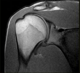csm s scan Shoulder SE T1 Coronal